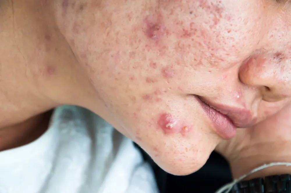 How to Treat Cystic Acne: Tips for Clearer Skin